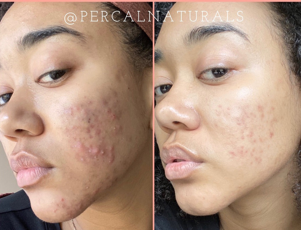 My Acne Story (and probably yours too!)