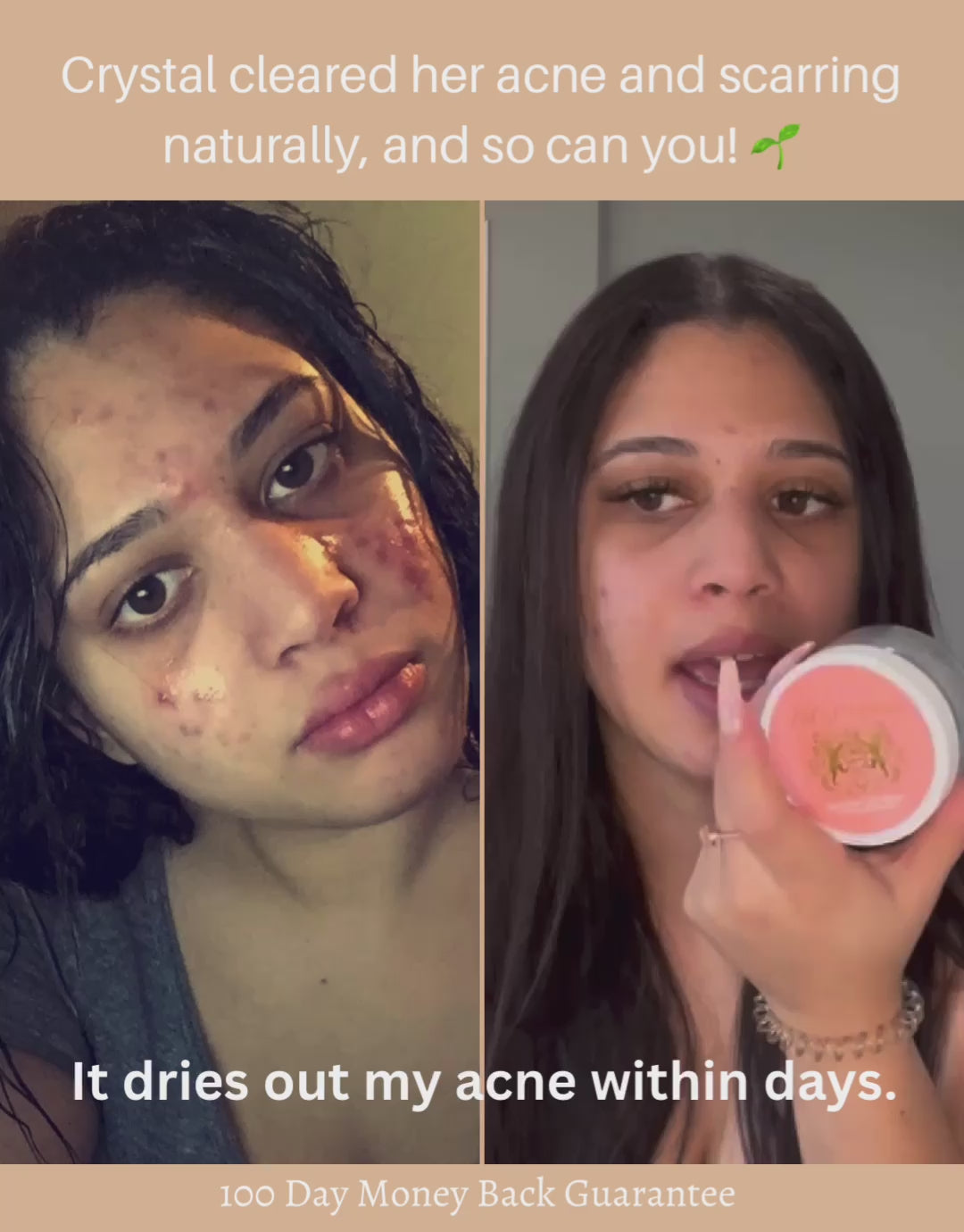 Complete Natural Acne Routine